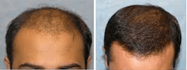 before and after hair transplant photo