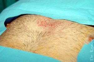 body hair transplant Turkey