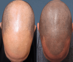 Micro Hair Pigmentation