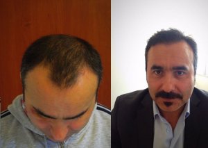 before and after hair transplant photo