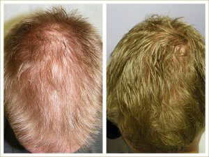 before and after hair transplant photo
