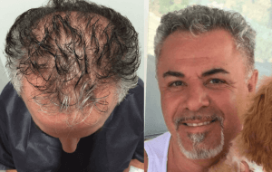 before and after hair transplant photo