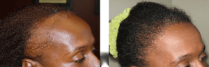 before after female hair transplant