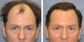 before and after hair transplant photo