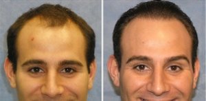before and after hair transplant photo