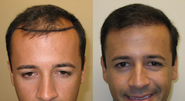 before and after hair transplant photo