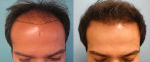 before and after hair transplant photo