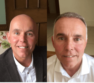 before-after-hairtransplant