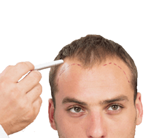 fue hair transplant men